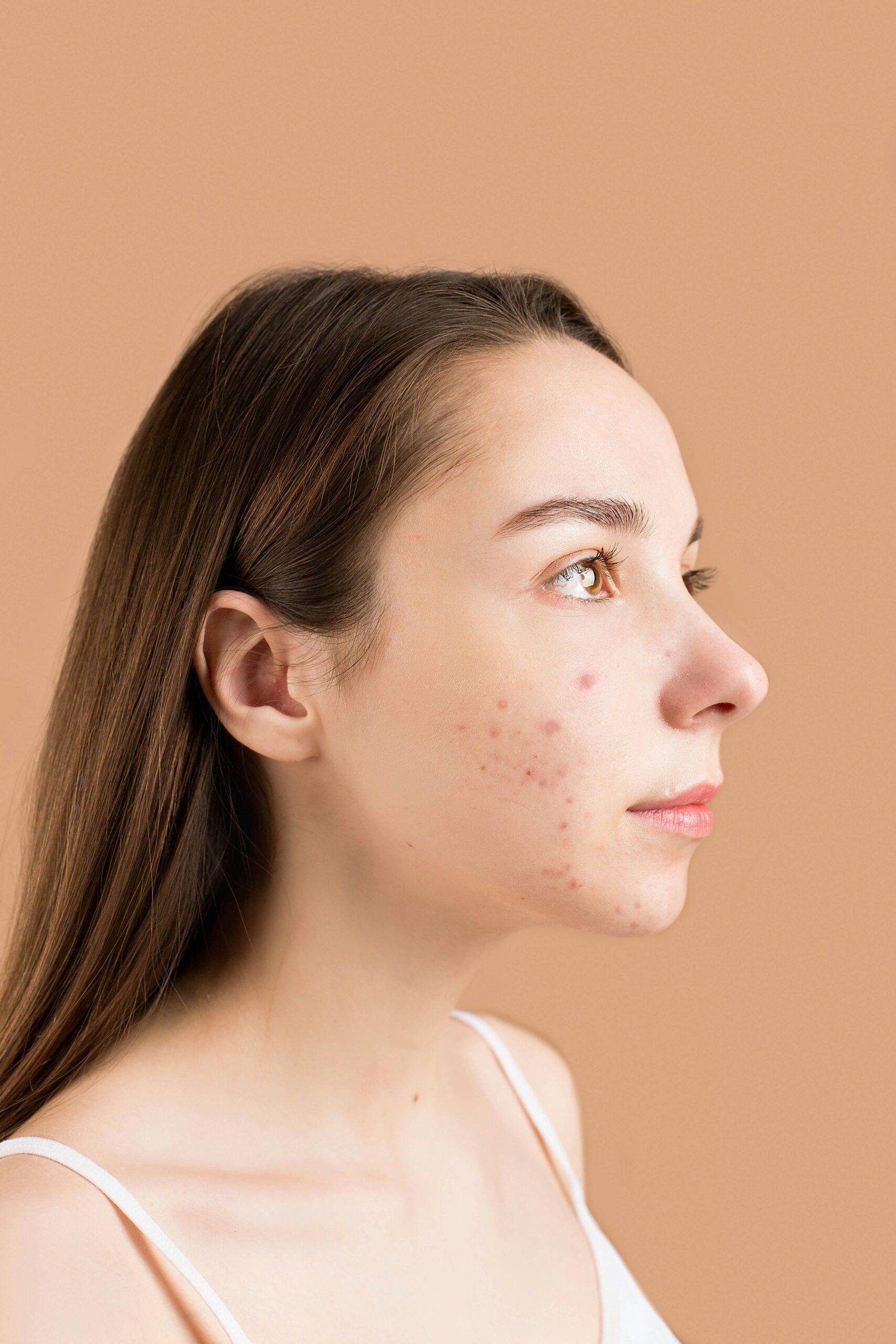 TLR-acne-stockimg